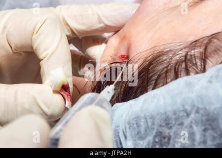 L'anesthésie du visage local : préparation pour affronter le levage à l'acide lactique poly ligne - Selective focus Banque D'Images