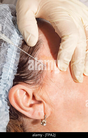 Le dermatologue effectue une anesthésie locale pour préparer le patient pour le visage pour le visage avec de l'acide lactique poly ligne - Selective focus Banque D'Images