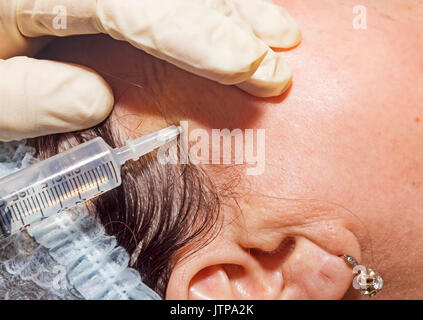Le dermatologue effectue une anesthésie locale pour préparer le patient pour le visage pour le visage avec de l'acide lactique poly ligne - Selective focus Banque D'Images