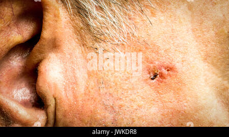 Un carcinome baso-cellulaire sur le visage de l'homme plus âgé avant chirurgie - libre Banque D'Images