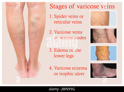 Varices sur une jambe senior femelle Banque D'Images