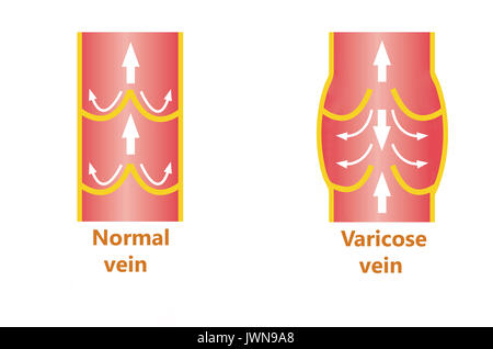 Les varices et les veines normales Banque D'Images