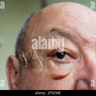 Portrait d'un homme âgé face avec œdème important des paupières après la chirurgie Banque D'Images