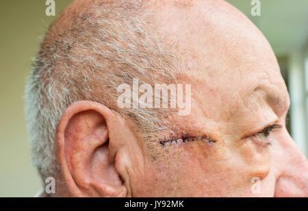 Portrait d'un homme âgé face avec œdème important des paupières après la chirurgie Banque D'Images