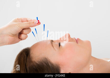 Close-up of Young Beautiful Woman recevant un traitement d'Acupuncture Banque D'Images