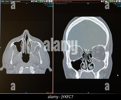 CT scan de mâle avec infection des sinus (sinusite) Remplissage du sinus maxillaire gauche. Septum dévié révèle également Banque D'Images