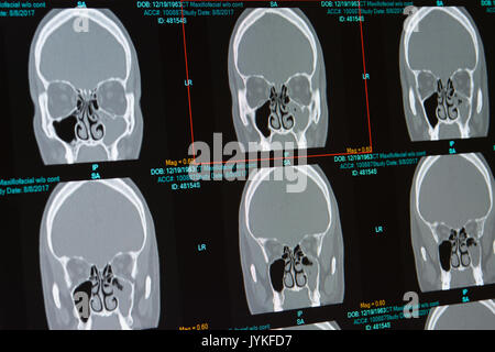 CT scan de mâle avec infection des sinus (sinusite) Remplissage du sinus maxillaire gauche. Septum dévié révèle également Banque D'Images