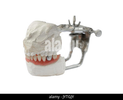 Dent artificielle, prothèse dentaire avec de fausses dents en métal argenté, la couronne sur la dent. Dentier Banque D'Images