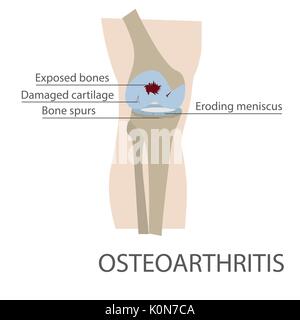 L'arthrose de l'articulation du genou maladie. format vecteur illustration Illustration de Vecteur