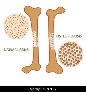 L'anatomie osseuse de l'ostéoporose et de la santé. l'os normal format vecteur illustration Illustration de Vecteur