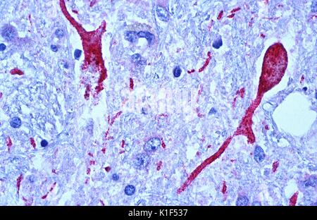 Photomicrographie de tissu cérébral d'un patient l'encéphalite du Nil occidental, montrant les neurones positifs à l'antigène et les processus neuronaux (en rouge). Image courtoisie CDC/W.-J. S. Shieh, Zaki, 1999. Banque D'Images