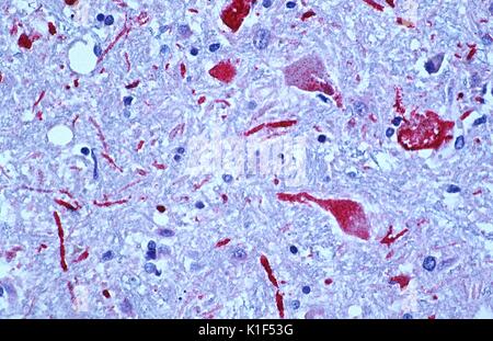 Photomicrographie de tissu cérébral d'un patient l'encéphalite du Nil occidental, montrant les neurones positifs à l'antigène et les processus neuronaux (en rouge). Image courtoisie CDC/W.-J. S. Shieh, Zaki, 1999. Banque D'Images