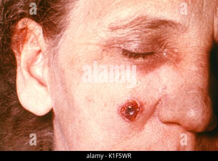 L'anthrax lésion de la peau sur le visage de l'homme l'image de ...