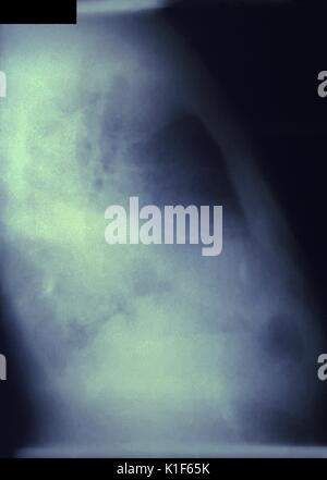 Ce droit-lateral chest x-ray a révélé des preuves d'une infection pulmonic 4 jours après ce patient avait été exposé à l'bacillus, Bacillus anthracis, la cause de la maladie connue sous le nom de l'anthrax. Tous les types de la maladie du charbon peut être prévenue et traitée avec des antibiotiques. Il y a un vaccin homologué pour prévenir la maladie du charbon, mais c'est seulement recommandé pour utilisation courante dans certains groupes d'adultes à risque. Si quelqu'un a des symptômes de la maladie du charbon, il est important de recevoir des soins médicaux le plus rapidement possible pour avoir les meilleures chances d'un rétablissement complet. Image courtoisie CDC/Sidney J. Brodsky, 1966. Banque D'Images