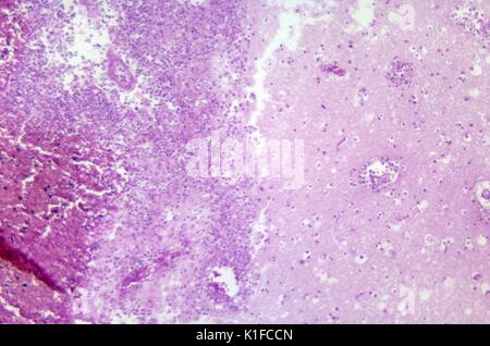 Cette Microphotographie d'un spécimen de tissu du cerveau montre les changements cytoarchitectural associées à une infection amibienne vivant librement, qui peut avoir été provoqué soit par une Naegleria fowleri Acanthamoeba, ou d'un sp. Les organismes vivants ont été trouvés dans le cerveau d'un prisonnier des Japonais dans les années 50, avant que nous sachions à propos de la vie amebae, libre et comment ils attaquent le cerveau. Dès que la vie amebae infecter le cerveau ou de la moelle épinière, la condition est connue comme une méningo-encéphalite amibienne primaire, ou PAM. Free-living amebae appartenant aux genres, Acanthamoeba, Balamuthia et Naegleria sont importants ca Banque D'Images