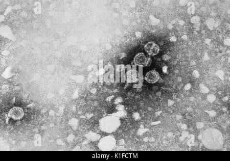 Cette micrographie électronique à transmission (MET) a révélé la présence d'hépatite B virions. Le grand tour sont connus sous le nom de virions particules de Dane. Voir PHIL 10755, pour une version colorisée de ce droit. Hépatite signifie inflammation du foie. Les toxines, certains médicaments, certaines maladies, une consommation élevée d'alcool, et les infections bactériennes et virales peuvent tous causer l'hépatite. L'hépatite est aussi le nom d'une famille d'infections virales, qui affectent le foie, les types les plus courants dans les États-Unis sont l'hépatite A, l'hépatite B et l'hépatite C. L'image de courtoisie CDC/Dr. Erskine Palmer, 1981. Banque D'Images