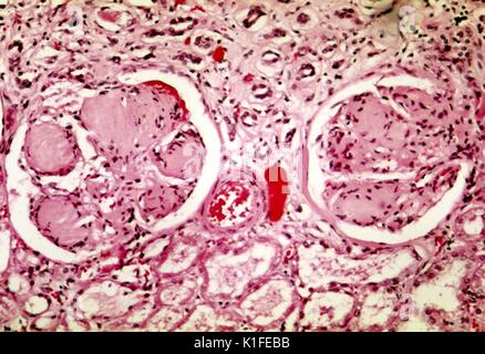 L'histopathologie de la glomérulosclérose nodulaire révélant des reins (syndrome de Kimmelstiel-Wilson), caractéristique du diabète. . Image courtoisie CDC/Dr. Edwin P. Ewing, Jr., 1974. Banque D'Images