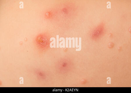 Les verrues de l'eau, le molluscum contagiosum, virus, sur fond d'un fout year old girl. Banque D'Images