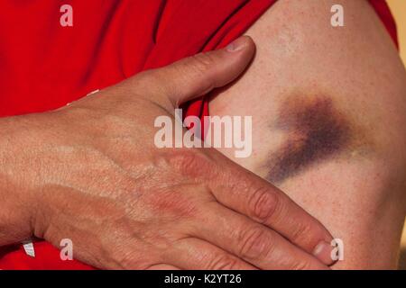 Grand bleu sur les mains des hommes. Accident douloureux. Bras gauche blessé Banque D'Images