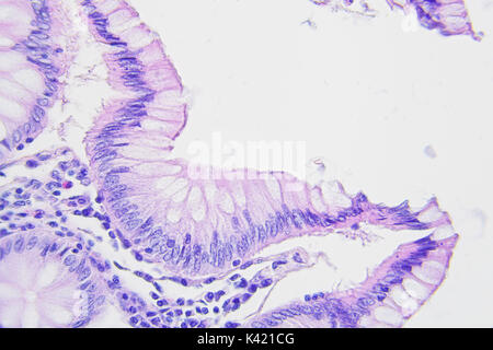 La photographie microscopique du cancer du côlon, grossissement x400 Banque D'Images