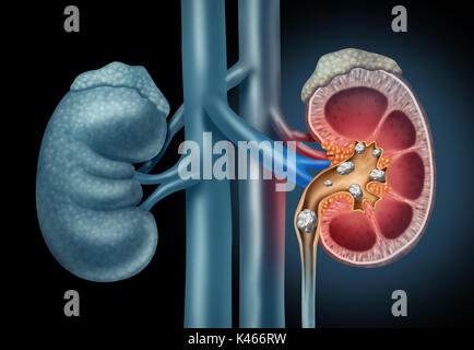 Pierres de rein humain concept médical comme un organe douloureux avec formations minérales cristallines comme un symbole de la médecine avec une section transversale avec 3D illustrat Banque D'Images