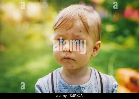 Une année malheureuse enfant avec des allergies et les piqûres sur le visage. portrait en jardin d'été. Banque D'Images