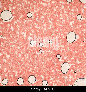 Frottis sanguin sous microscope présente des neutrophiles et globules rouges. photo micro sections avec un fort grossissement au microscope optique avec Banque D'Images