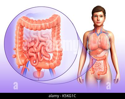 Illustration d'une femme avec le diverticulosis dans la première partie du gros intestin. Banque D'Images