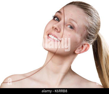 Femme avec des problèmes de peau avant et après le traitement et de make-up sur fond blanc. Banque D'Images