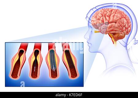 Illustration de l'angioplastie stent du cerveau pour traiter et prévenir un AVC. Banque D'Images