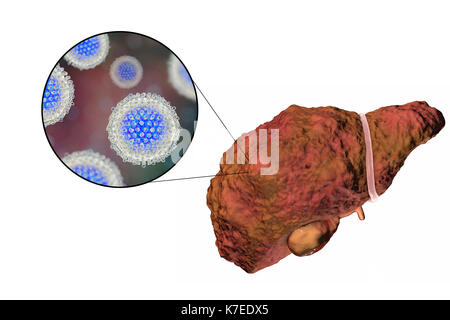 Illustration d'ordinateur d'un foie cirrhotique et un close-up de l'hépatite C les virus. L'hépatite C est une cause fréquente de l'hépatite chronique qui évolue vers la cirrhose du foie. Les virus causent la mort cellulaire (nécrose) dans les lobules hépatique, ce qui conduit à des cicatrices. Ceci provoque la surface du foie à apparaître de manière irrégulière et de bosses au lieu de l'habituelle bonne apparence saine. La maladie est irréversible et peut conduire à un cancer du foie. Banque D'Images