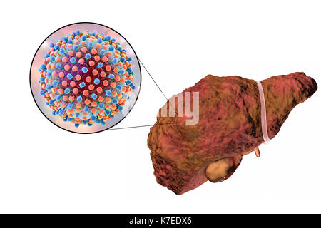 Illustration d'ordinateur d'un foie cirrhotique et un close-up de l'hépatite C les virus. L'hépatite C est une cause fréquente de l'hépatite chronique qui évolue vers la cirrhose du foie. Les virus causent la mort cellulaire (nécrose) dans les lobules hépatique, ce qui conduit à des cicatrices. Ceci provoque la surface du foie à apparaître de manière irrégulière et de bosses au lieu de l'habituelle bonne apparence saine. La maladie est irréversible et peut conduire à un cancer du foie. Banque D'Images