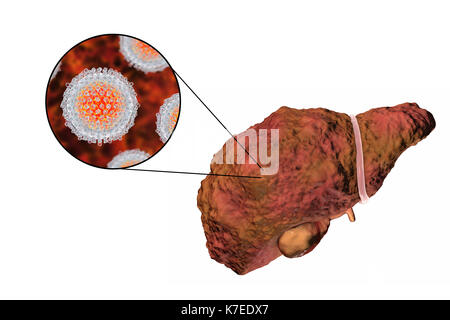 Illustration d'ordinateur d'un foie cirrhotique et un close-up de l'hépatite C les virus. L'hépatite C est une cause fréquente de l'hépatite chronique qui évolue vers la cirrhose du foie. Les virus causent la mort cellulaire (nécrose) dans les lobules hépatique, ce qui conduit à des cicatrices. Ceci provoque la surface du foie à apparaître de manière irrégulière et de bosses au lieu de l'habituelle bonne apparence saine. La maladie est irréversible et peut conduire à un cancer du foie. Banque D'Images