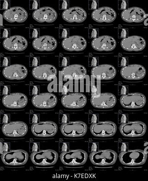 Anatomie de l'abdomen et de la poitrine. Série de la tomodensitométrie (CT) analyse de sections transversales à travers la partie supérieure de l'abdomen et la partie inférieure de la poitrine d'un patient âgé de 30 ans. Ils montrent le foie (à gauche), l'intestin (à droite), de la colonne vertébrale (en bas), les reins (en bas à gauche et droit), le coeur (en haut de la dernière ligne d'images) et lobes inférieurs de poumons (noir en dernière ligne d'images). Banque D'Images