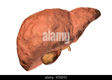 Les droits de la stéatose hépatique montrant des signes de fibrose, illustration de l'ordinateur. Banque D'Images