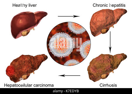 Le foie humain montrant stades de la maladie du foie au cours de l'infection virale de l'hépatite C, l'illustration de l'ordinateur. Banque D'Images