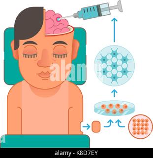 La transplantation de cellules du cerveau concept illustration Illustration de Vecteur