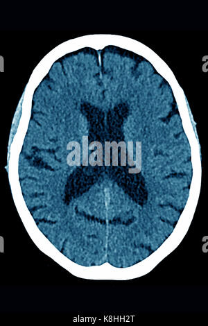 Une atrophie cérébrale, scanner Banque D'Images