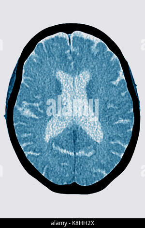 Une atrophie cérébrale, scanner Banque D'Images