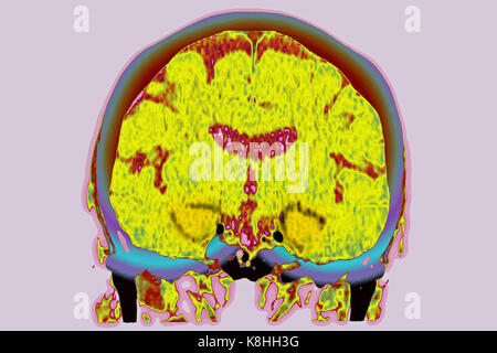 Une atrophie cérébrale, scanner Banque D'Images
