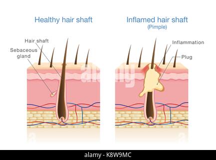 L'infection dans les follicules de cheveux. Illustration de Vecteur