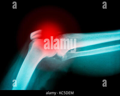 X-ray de bras humain montrant os cassé avec surbrillance rouge Banque D'Images