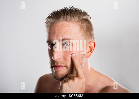 Man squeezing bouton sur son visage. problème de peau d'acné Banque D'Images