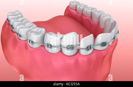 Dents avec accolades processus d'alignement. Illustration 3d médicalement précise Banque D'Images