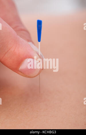 Macro détail d'Une main stimulant une aiguille d'acupuncture au dos d'Un patient Banque D'Images