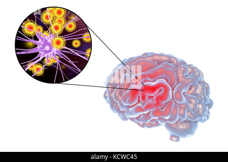 Encéphalite virale. Conceptual illustration du cerveau et close-up view of virus infectant les neurones. Banque D'Images