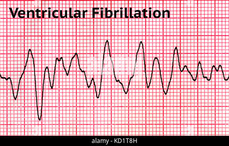 La fibrillation ventriculaire (FV) Banque D'Images