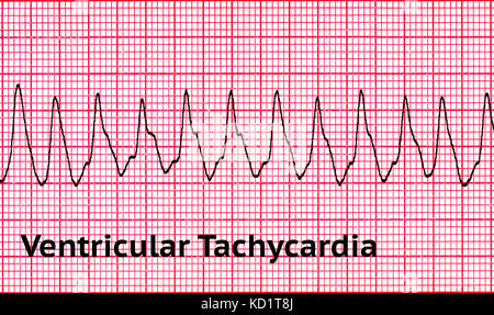 La tachycardie ventriculaire (TV) Banque D'Images