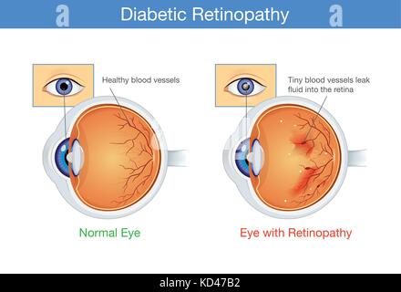 Anatomie de l'œil normal et la rétinopathie diabétique. Illustration de Vecteur