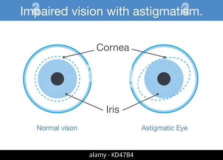 La vision normale et les troubles de la vision avec l'astigmatisme en vue de face. Illustration de Vecteur